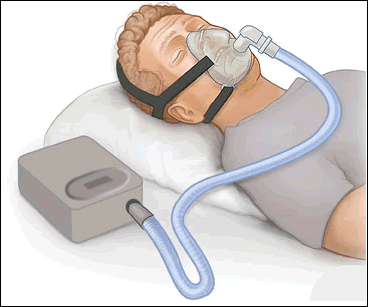 CPAP CPAP