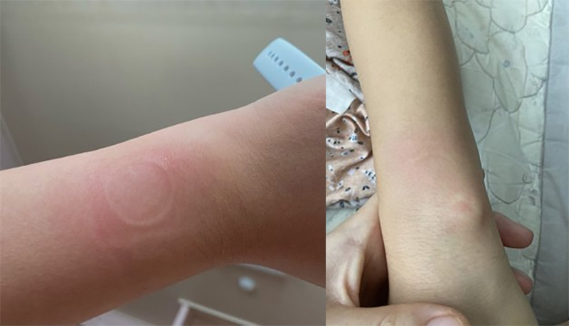 Apple Watch SE 用戶因手錶過熱燙傷手腕,顯示器也跟著損壞 - 電腦王阿達 Apple Watch SE 用戶因手錶過熱燙傷手腕,顯示器也跟著損壞 - 電腦王阿達