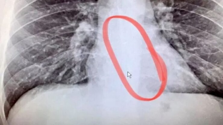 Swallowed-AirPods-740x416 Swallowed-AirPods-740x416