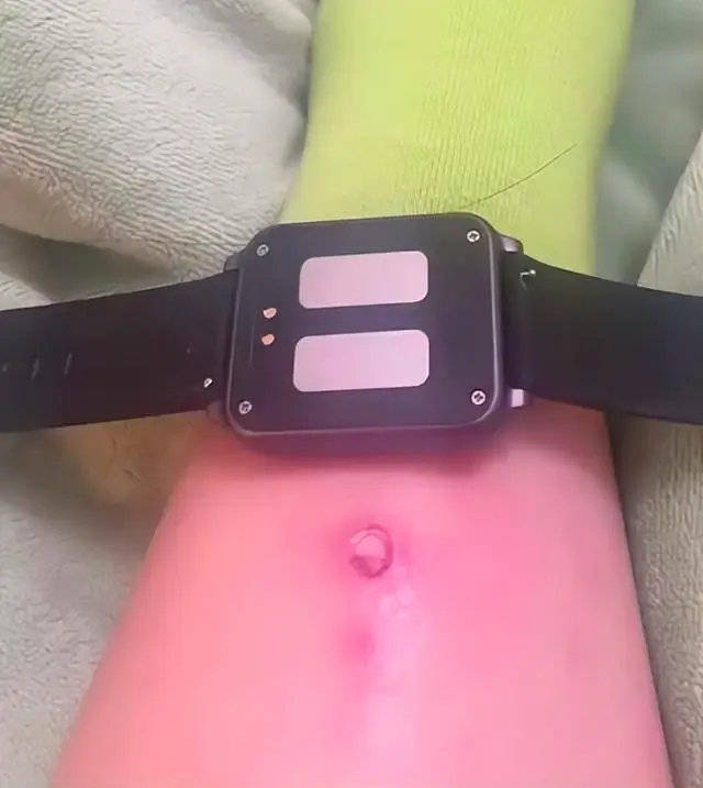 中國女大生為了早起使用電擊手錶並設置最高 480V 電壓,結果睡死導致腳踝燒傷破皮 - 電腦王阿達 中國女大生為了早起使用電擊手錶並設置最高 480V 電壓,結果睡死導致腳踝燒傷破皮 - 電腦王阿達