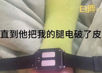 中國女大生為了早起使用電擊手錶並設置最高 480V 電壓，結果睡死導致腳踝燒傷破皮