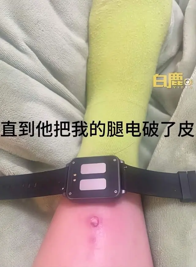 中國女大生為了早起使用電擊手錶並設置最高 480V 電壓,結果睡死導致腳踝燒傷破皮 - 電腦王阿達 中國女大生為了早起使用電擊手錶並設置最高 480V 電壓,結果睡死導致腳踝燒傷破皮 - 電腦王阿達