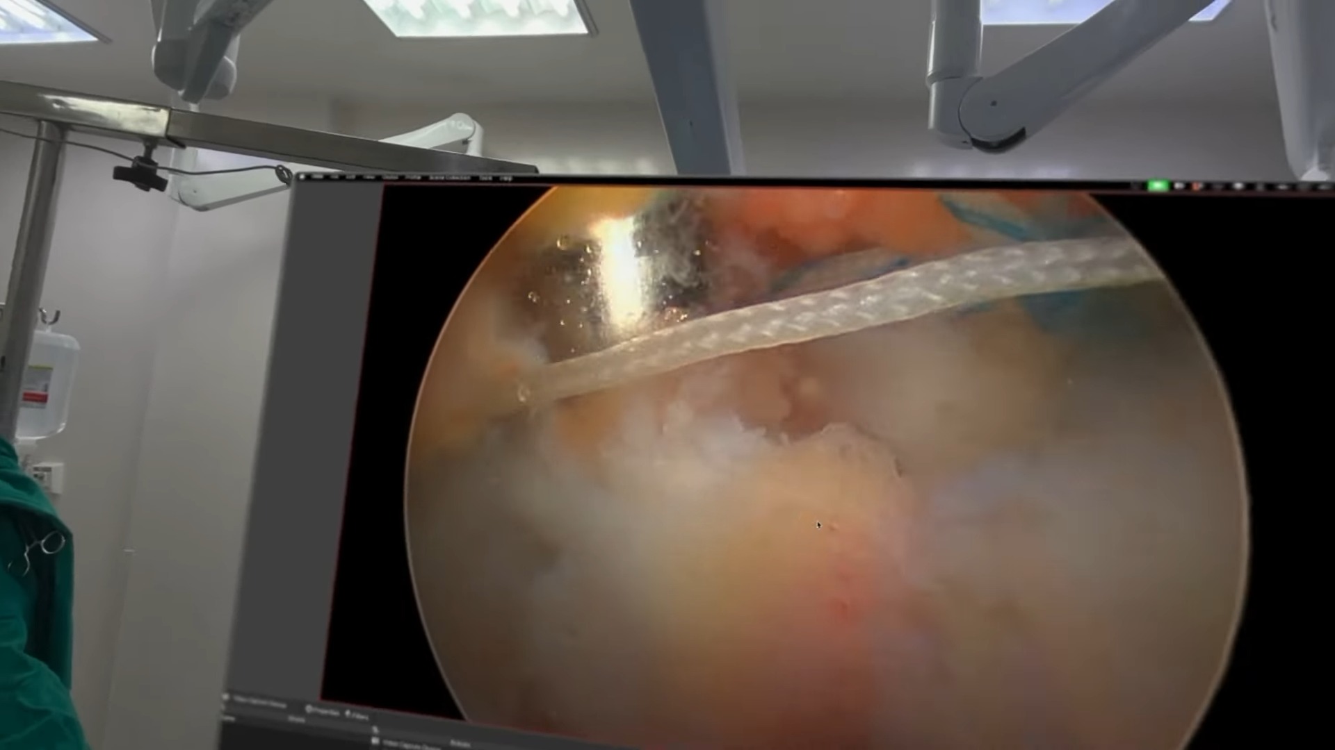 Apple Vision Pro 再度登上手術檯!巴西醫生用它進行肩關節鏡手術 - 電腦王阿達 Apple Vision Pro 再度登上手術檯!巴西醫生用它進行肩關節鏡手術 - 電腦王阿達