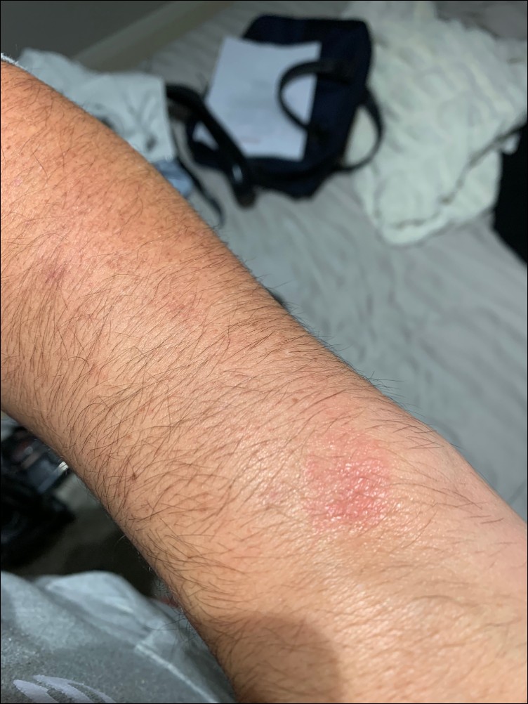 印度用戶控訴 Apple Watch 灼傷手腕,維權半年無果怒批客服「踢皮球」 - 電腦王阿達 印度用戶控訴 Apple Watch 灼傷手腕,維權半年無果怒批客服「踢皮球」 - 電腦王阿達