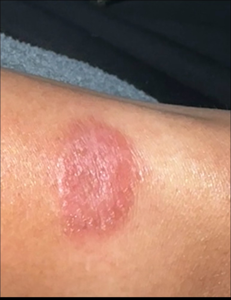印度用戶控訴 Apple Watch 灼傷手腕,維權半年無果怒批客服「踢皮球」 - 電腦王阿達 印度用戶控訴 Apple Watch 灼傷手腕,維權半年無果怒批客服「踢皮球」 - 電腦王阿達